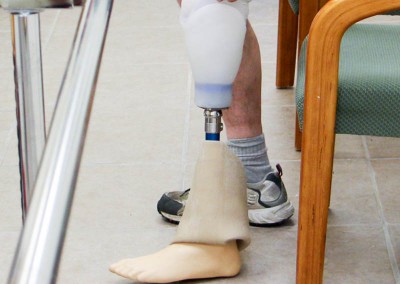 Lower Extremity Prosthetics